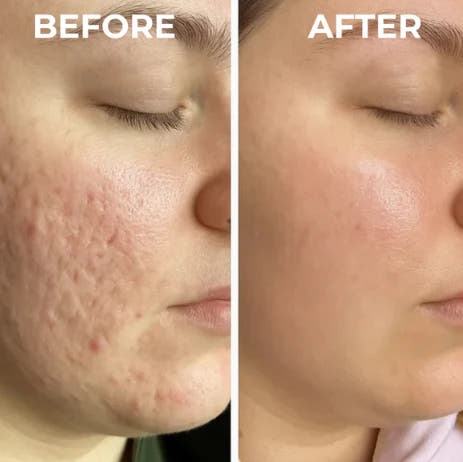 Silicone Scar Sheets | Wake Up to Smoother Skin and a Appearance That Looks 5 Years Younger