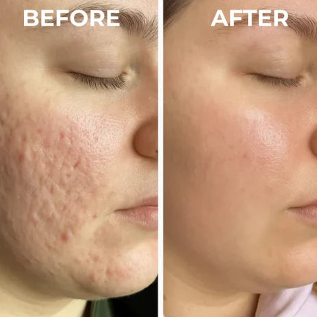 Silicone Scar Sheets | Wake Up to Smoother Skin and a Appearance That Looks 5 Years Younger