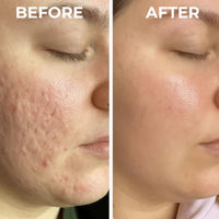 Silicone Scar Sheets | Wake Up to Smoother Skin and a Appearance That Looks 5 Years Younger