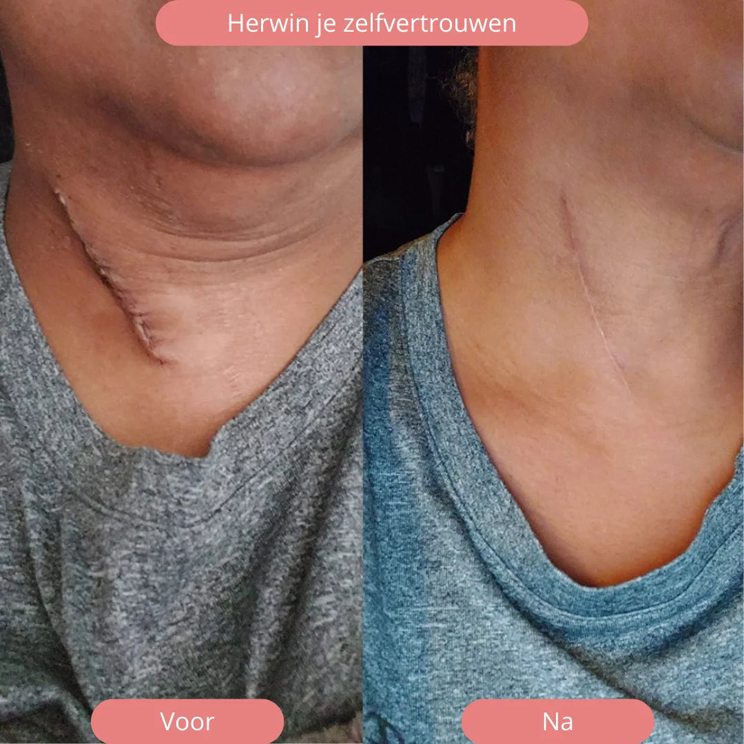 Silicone Scar Sheets | Wake Up to Smoother Skin and a Appearance That Looks 5 Years Younger