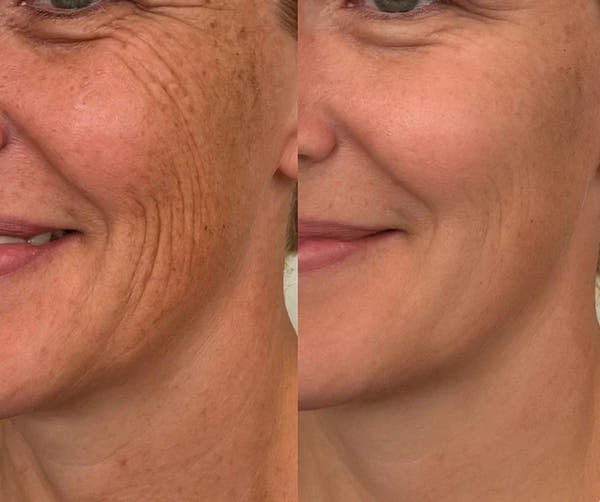 Silicone Scar Sheets | Wake Up to Smoother Skin and a Appearance That Looks 5 Years Younger